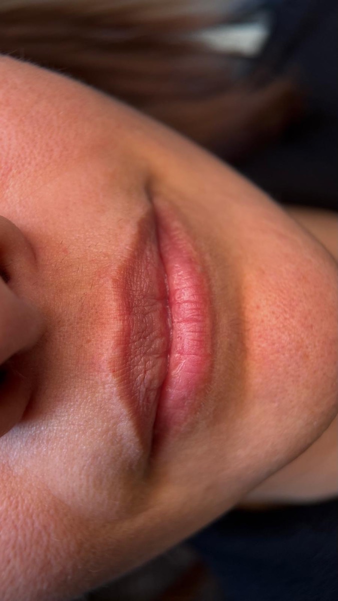 Lippen vorher – zarte natürliche Farbe ohne erkennbare Kontur